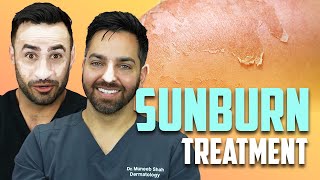 SUNBURN - How To Treat a Sunburn like a Dermatologist