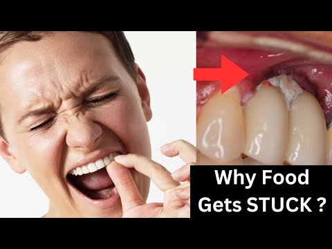 Why FOOD gets stuck BETWEEN your teeth and How to FIX it ?