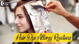 Allergic reaction to hair dye and face swelling? - Dr. Rashmi Ravindra | Doctors