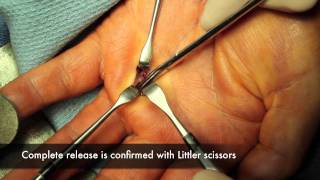 Live Surgery Trigger Finger Release in the Hand