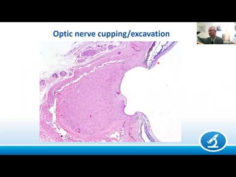 AANP Teaching Rounds - November 28 - The Pathology of Glaucoma