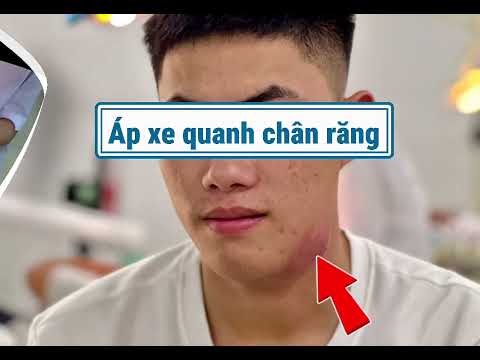 NHỔ RĂNG BẰNG CÔNG NGHỆ PIEZOTOME TẠI BVĐK HOẰNG HOÁ