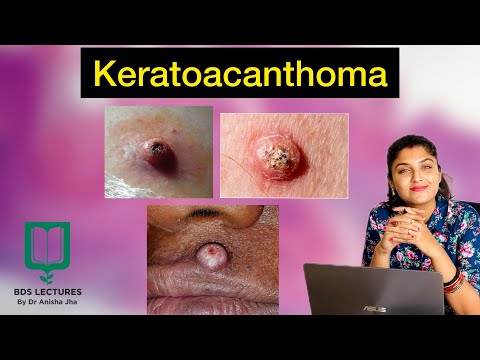 Keratoacanthoma | Lecture 26 | Skin Tumour | Skin lesion | Epithelial Tumour | Oral Pathology |