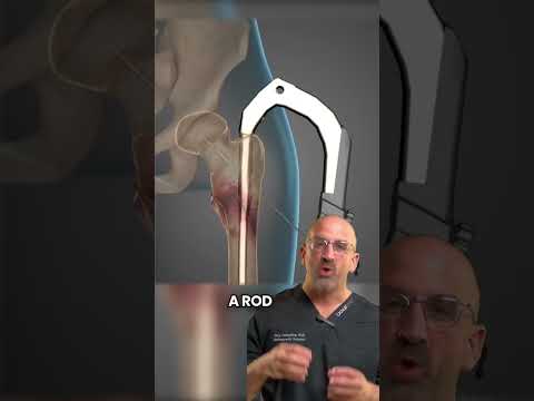 Femoral Nail 🔨 Hip Fracture Surgery #shorts