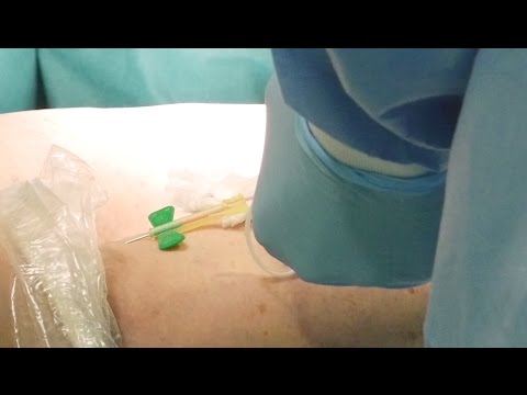 varicoza nava de spargere crampe în picioare în varicoza