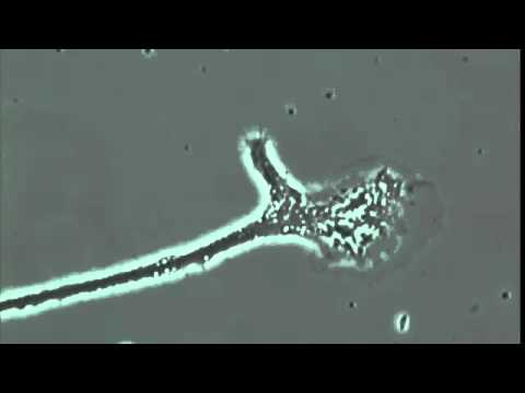 amalgama dentale, cosa succede alle cellule cerebrali