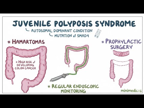 Juvenile polyposis syndrome | colorectal cancer 
