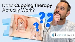 Does Cupping Work | Expert Physio Review