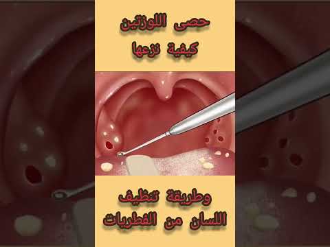 , title : '#حصى اللوزتين -علاجها وطريقة تنظيف اللسان من الفطريات'