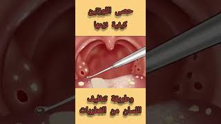 حصى اللوزتين علاجها وطريقة تنظيف اللسان من الفطريات