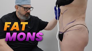 Solving the Fat Mons Issue After a Tummy Tuck: Real Patient Case
