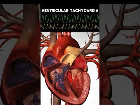 ECG rhythms with Heart Animation (Normal sinus, V. Tach, V. Fib, Asystole) #shorts #ecg #cardiology