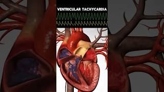 ECG rhythms with Heart Animation (Normal sinus, V. Tach, V. Fib, Asystole) #shorts #ecg #cardiology
