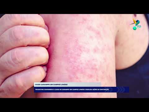 Casos de sarampo em Campos Lindos