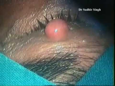 Hpv herpes treatment