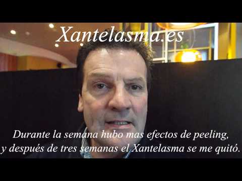 XanthRemover testimonio de Stephen
