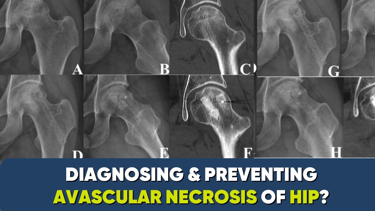 Avascular Necrosis (AVN):Guide to Early Detection Diagnosis + Management and Prevention