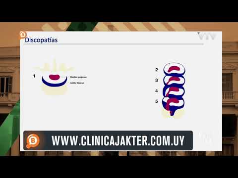 Dolor de espalda por Protrusión Discal - Dr. Isaac Jakter