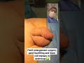 Penil Enlargement Surgery Penil Lipofilling And Stem Cell Therapy In Andrology Dr Araz Bayramov
