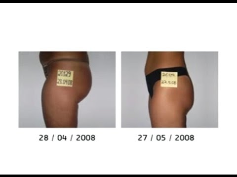 Liposhaper a primeira "lipoaspiração" não invasiva