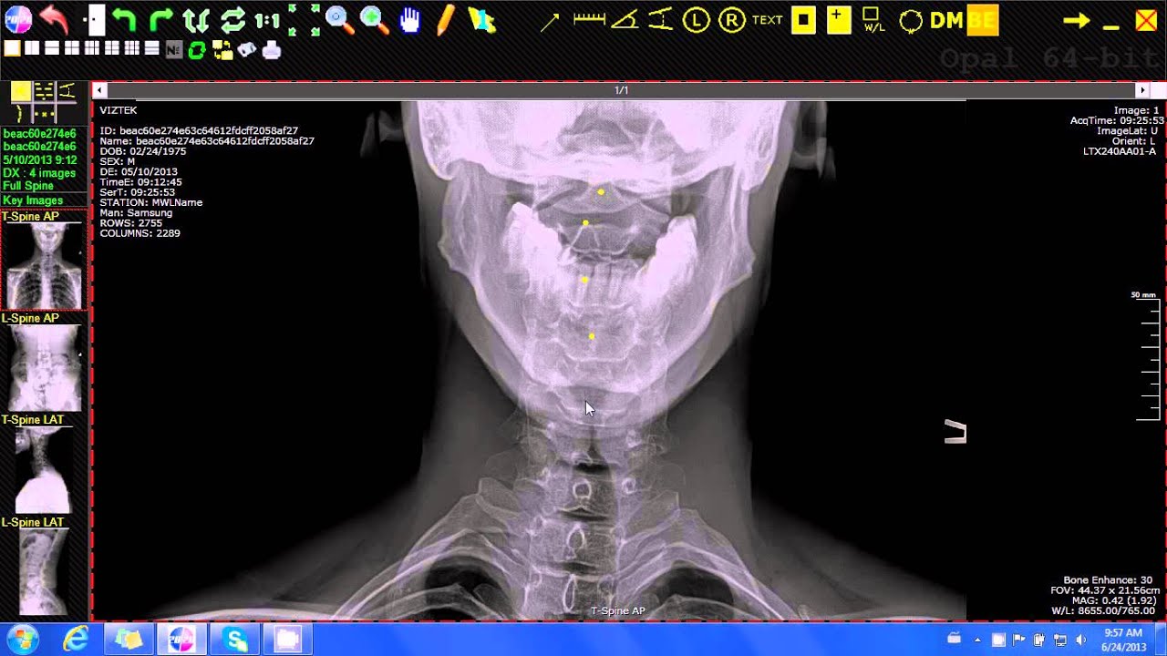 20/20 Imaging Opal-Rad (Chiropractic) Mark Spot Tool