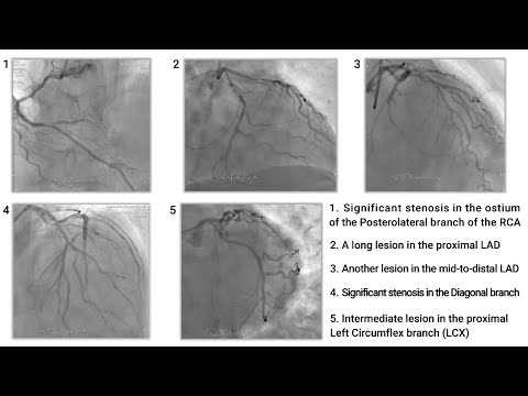 Eight FFR measurements using one TruePhysio Rx Pressure Microcatheter