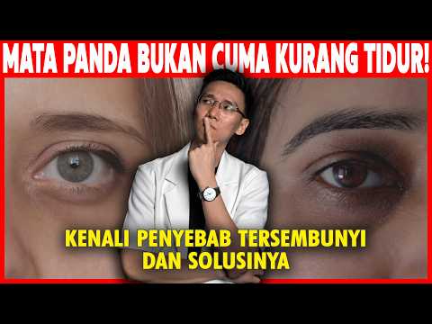 Waspada! Lingkaran Hitam di Bawah Mata Bisa Jadi Sinyal Tubuh Anda Bermasalah | Mata Panda