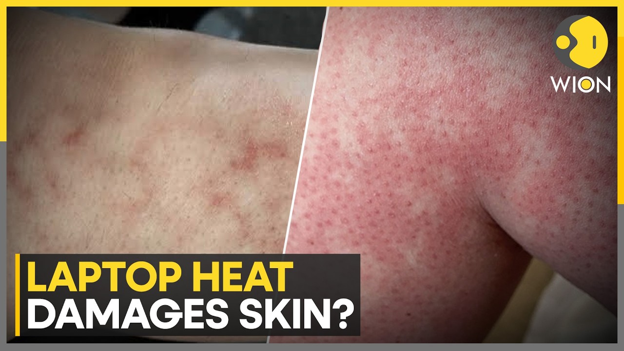 Toasted Skin Syndrome In Children | How Prolonged Laptop Heat Can Cause Skin Damage