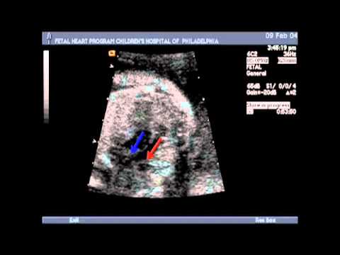 Identifying Transposition of the Great Arteries with Fetal Echocardiogram | Children's Hospital of Philadelphia