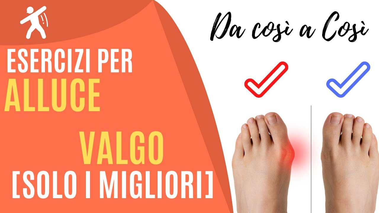 Watch Now Alluce Valgo | 4 Esercizi e Strategie per non operarsi Alluce Valgo | 4 Esercizi e Strategie per non operarsi