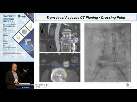 M. Kasel | The rapid emergence of transcaval TAVR. Techniques and clinical outcomes.