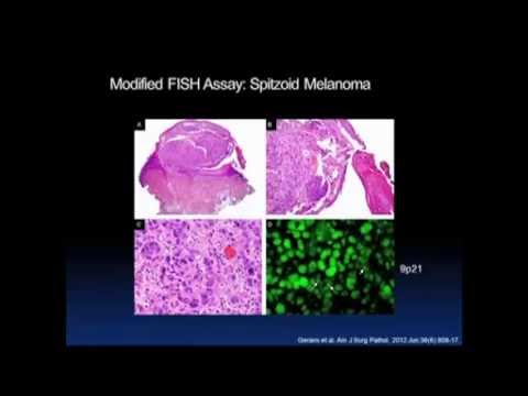 LMP: Molecular Pathways in Cutaneous Melanomas - Nils Becker M.D.