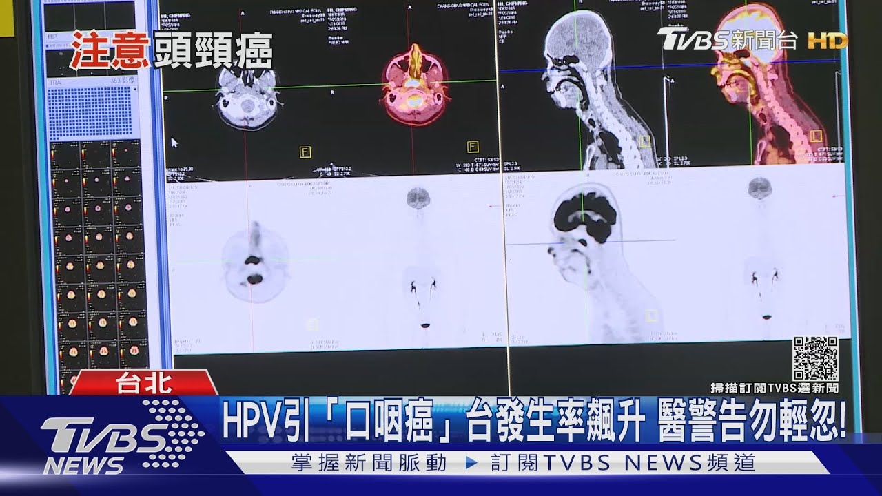 有片/感染「這種病毒」產生癌化引起頭頸癌 醫師:沒做這件事!