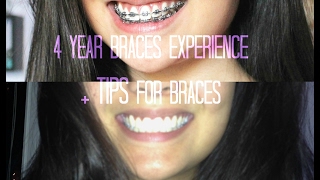 MY 4 YEAR BRACES EXPERIENCE 2017 + Tips for Braces, Retainers, and Bracket Stains