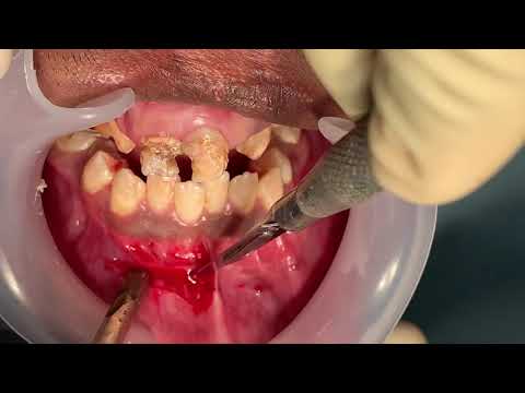 Revision Genioplasty