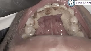 Can You Watch Till the End? Top 3 Most Impressive  Tartar Removals!#