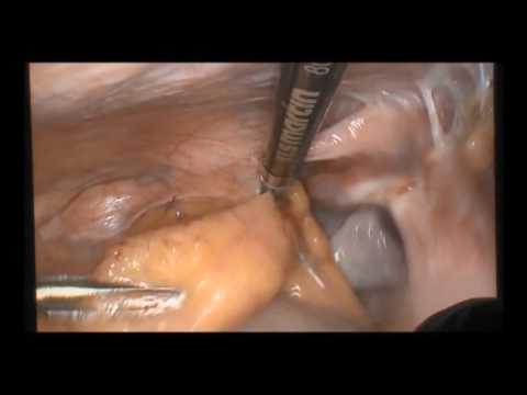 marSeal5 IQ and maXium® – Laparoscopic hysterectomy