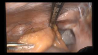 marSeal5 IQ and maXium® | Laparoscopic hysterectomy