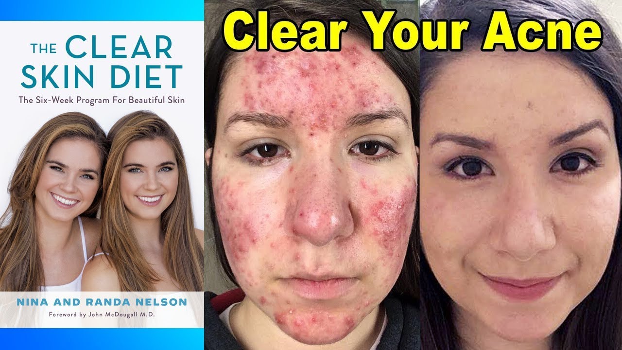 Clear Cystic Acne with Diet – Nina & Randa (20:30)