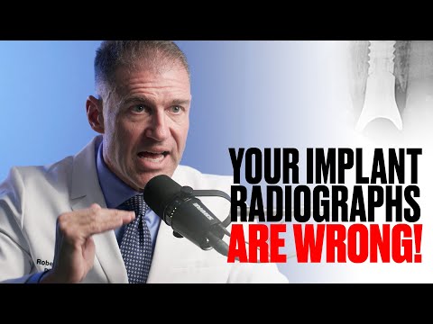 Your Dental Implant X-Rays ARE NOT Measuring Crestal Bone Loss.