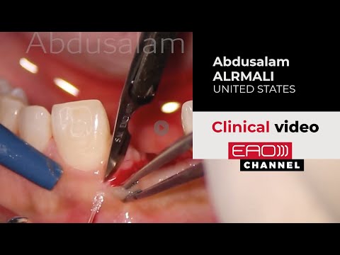 Crown And Abutment Removal With Temporary Implant Submergence