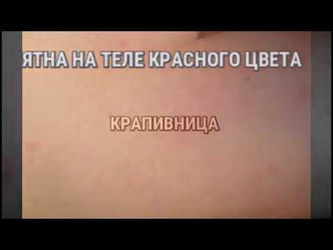 Грыжи межпозвонкового диска лечение Температура и боль в суставах при ангине