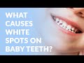 What Causes White Spots On Baby Teeth? | AC Pediatric Dentistry & Orthodontics