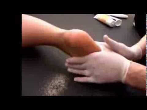 ส้นเท้าแตก