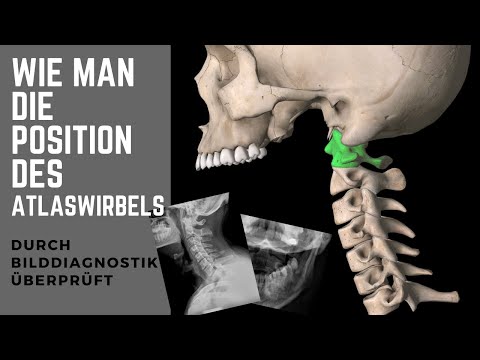 Wie eine geschwollene Fußgelenke behandeln Chirurgie der Kniearthrose