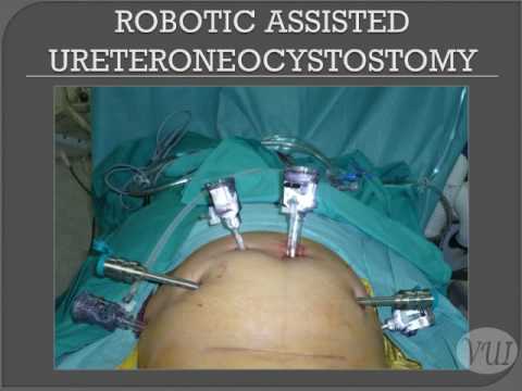Leczenie chirurgiczne przetoki moczowodowo-pochwowej w asyście robota 