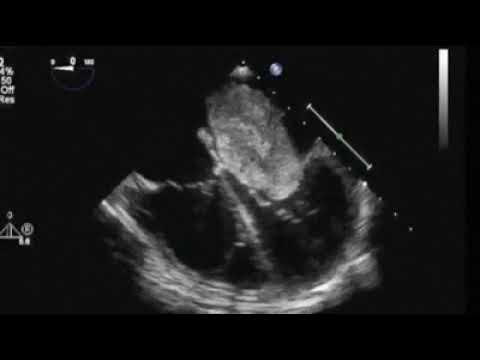 Atrial Myxoma in Echocardiography  || Dr. Shankar Dey