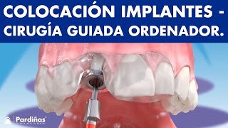 Cirugía guiada por ordenador para colocar implantes dentales ©