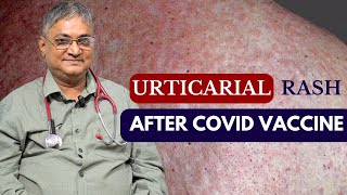 URTICARIAL RASH AFTER COVID VACCINE