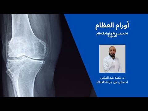 معلومات تهمك عن أورام العظام - الحلقة الأولى